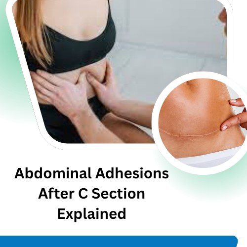 Abdominal Adhesions After C Section Explained: Symptoms, Causes, and Treatments - Herbal Care Products - Blog