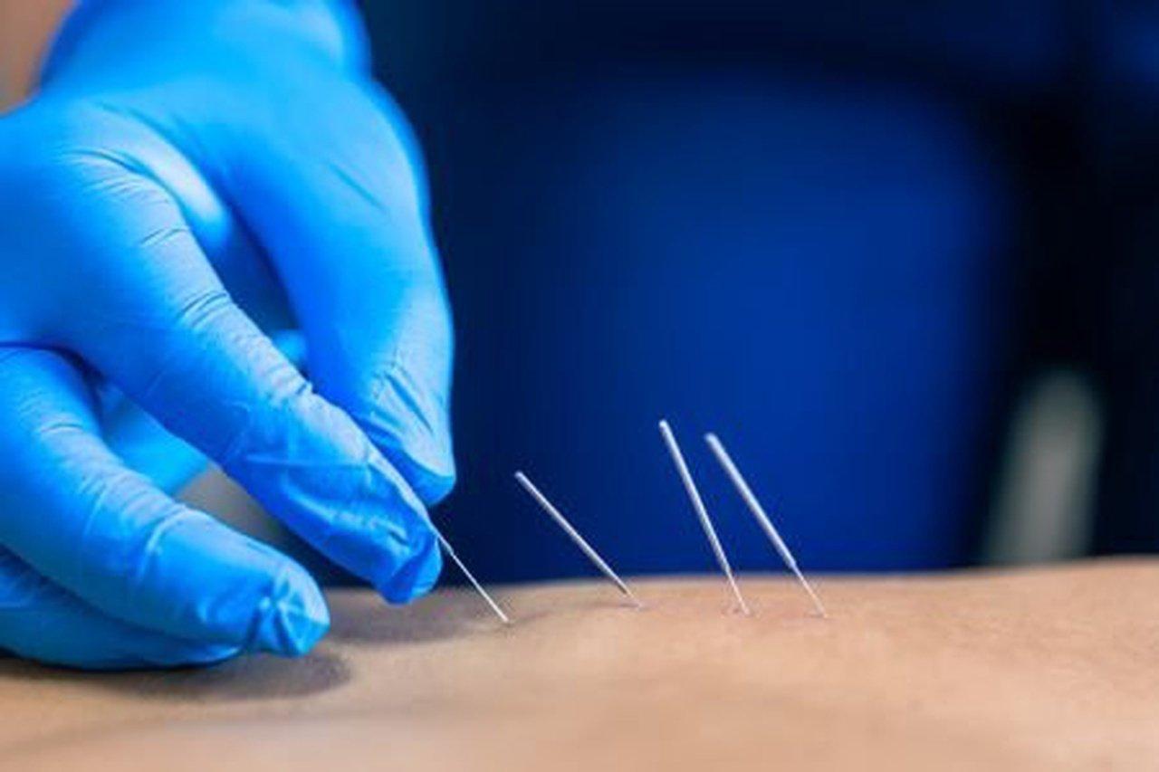 How Precision Needling Techniques Speed Up Muscle Recovery Safely | Articles | matthewhamilton | Gan Jing World - Technology for Humanity | Video & Movie Streaming
