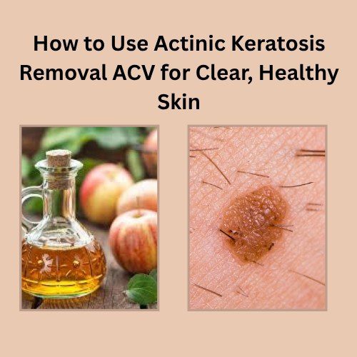 How to Use Actinic Keratosis Removal ACV for Clear, Healthy Skin