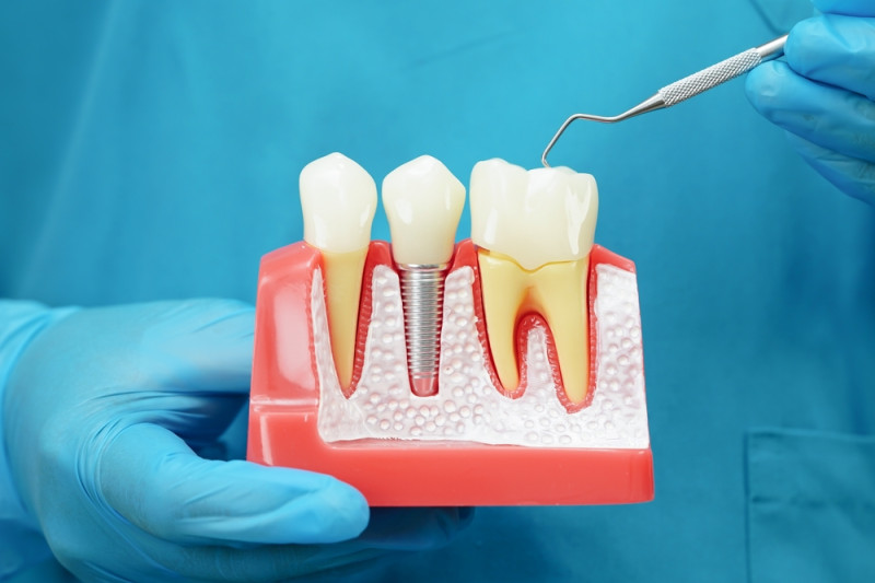 A Complete Guide to Dental Implants in Oakville, ON