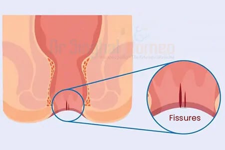 Get Permanent Anal Fissure Treatment in Homeopathy