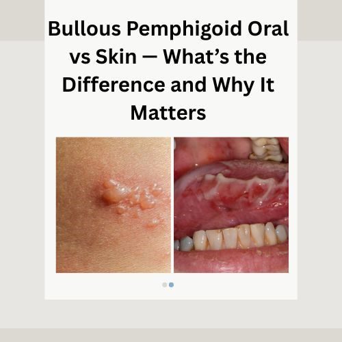Bullous Pemphigoid Oral vs Skin — What’s the Difference and Why It Matters - Herbal Care Products - Blog