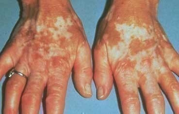 Vitiligo Treatment in Homeopathy – Safe, Gentle & Holistic Healing