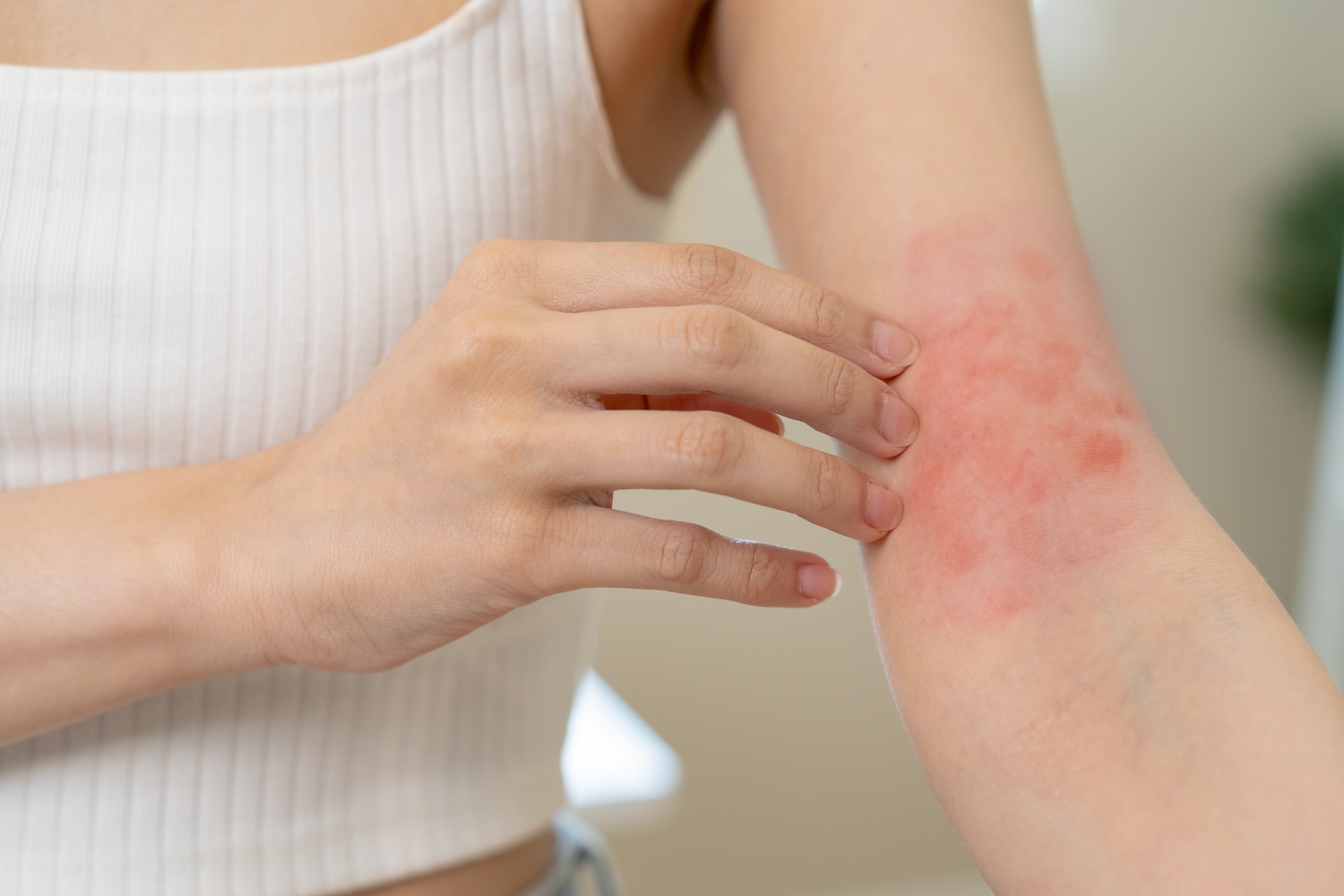 Natural Remedies for Irritated Skin: What Works and What Doesn’t - Natural Health News