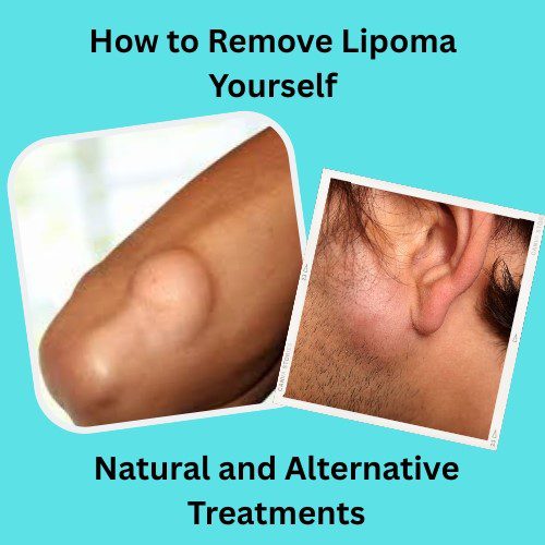 How to Remove Lipoma Yourself: Natural and Alternative Treatments - Herbal Care Products - Blog