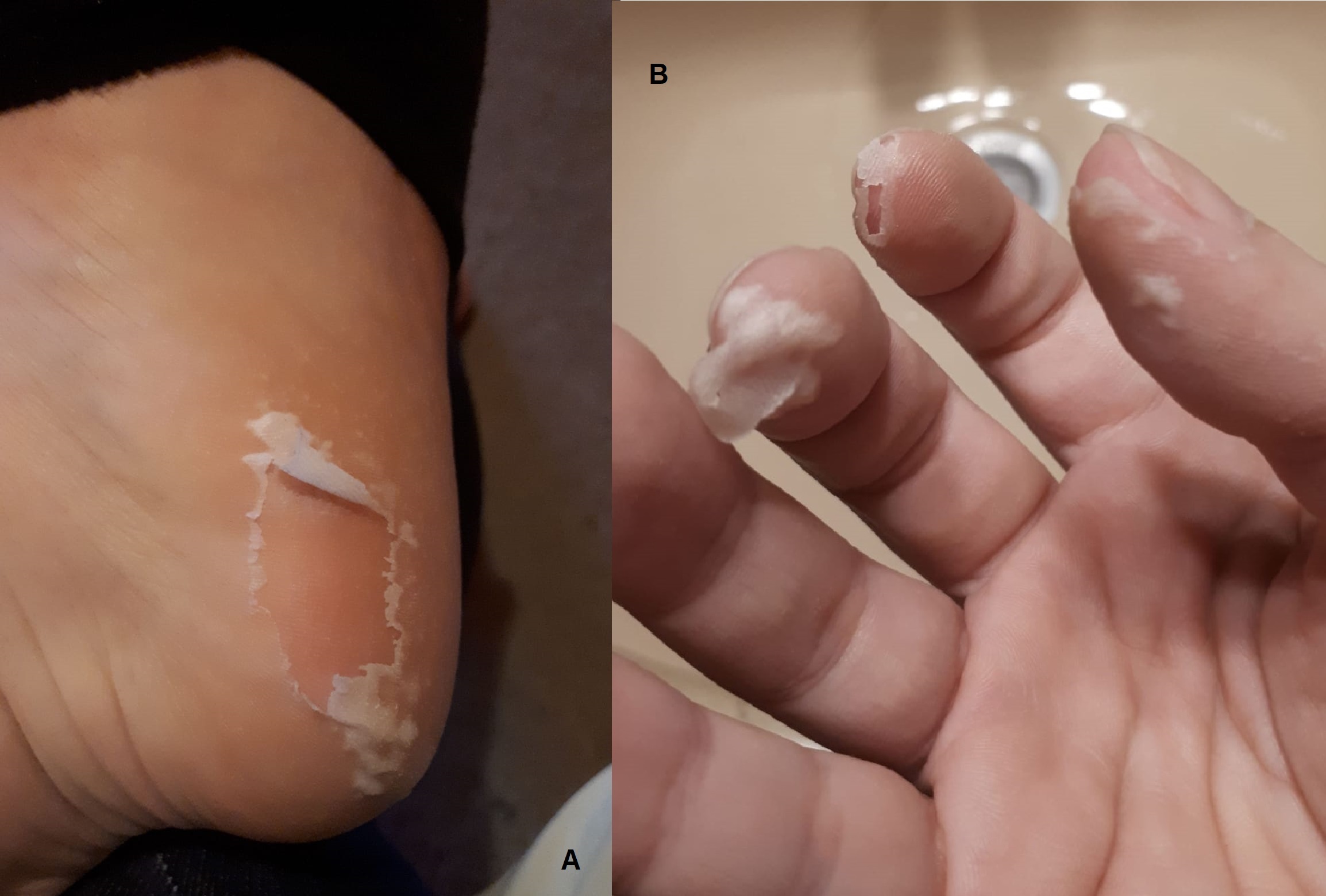 Skin Peeling After Hand Foot Mouth Disease: Surprising Herbal Remedies - Biz DirectoryHub