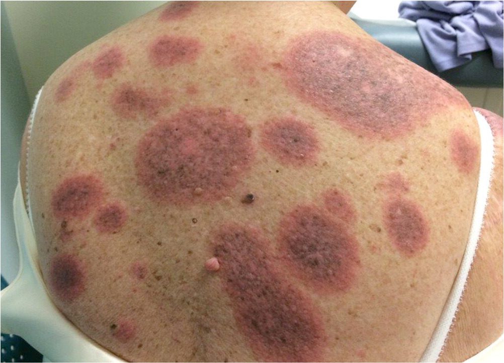 Granuloma Annulare Cancer Risk: The Hidden Link You Must Not Ignore - Herbal Care Products - Blog