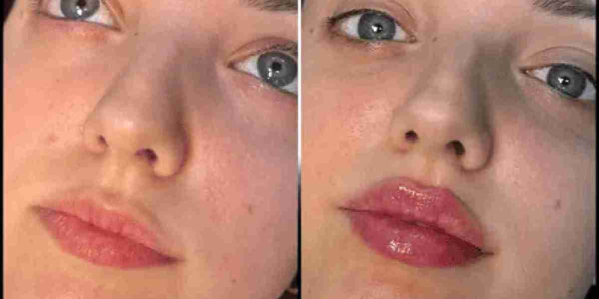 Best Plastic Surgeon in dubai for Fillers: Safe, Gentle, Effective