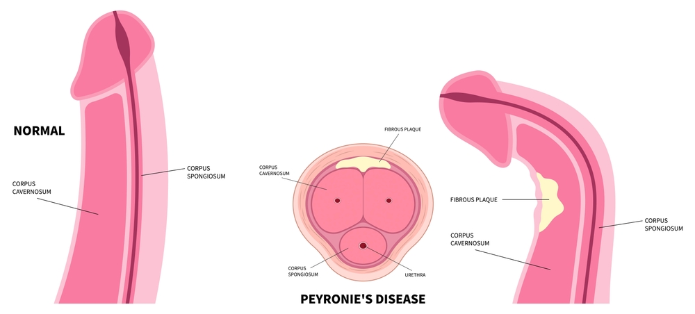 Trusted Peyronies Disease Wave Therapy in Burlington, ON