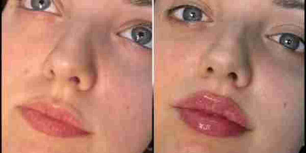 Best Plastic Surgeons in Dubai for High-Quality Aesthetic Fillers