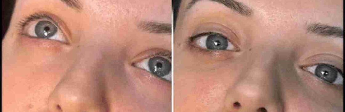 dermal fillers Cover Image