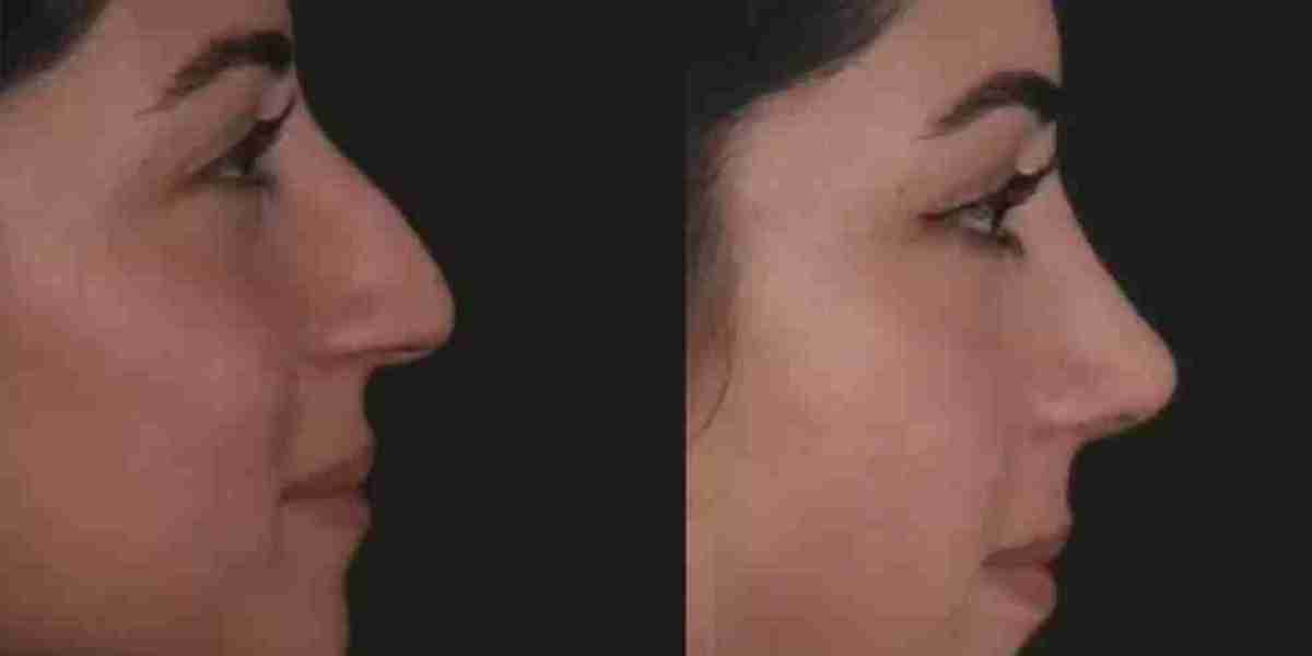 Septoplasty in Dubai for Long-Term Breathing Comfort