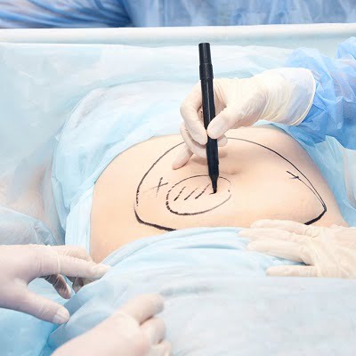 Tummy Tuck in Islamabad Pakistan - Royal Cosmetic Surgery